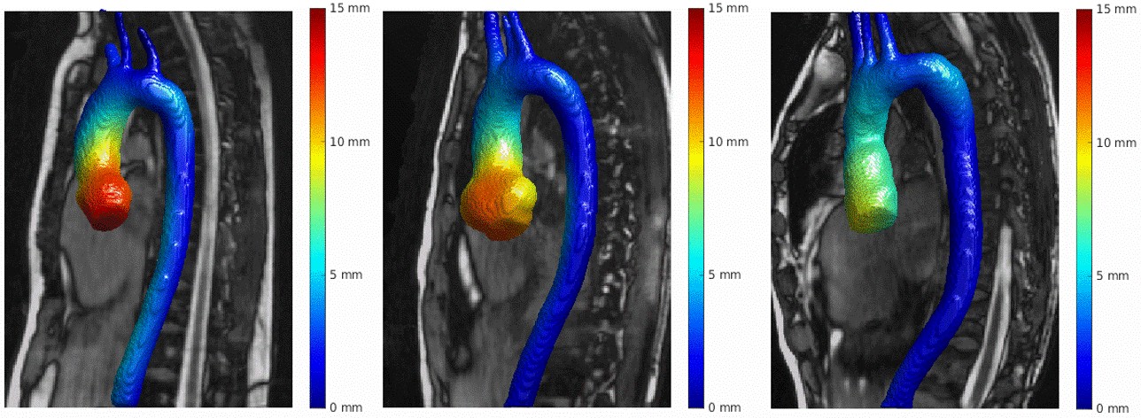 Figure 2: Quantification of aortic displacement over heartbeat. Left: healthy volunteer; center: Marfan patient who has not undergone surgery; right: Marfan patient after aortic root replacement surgery