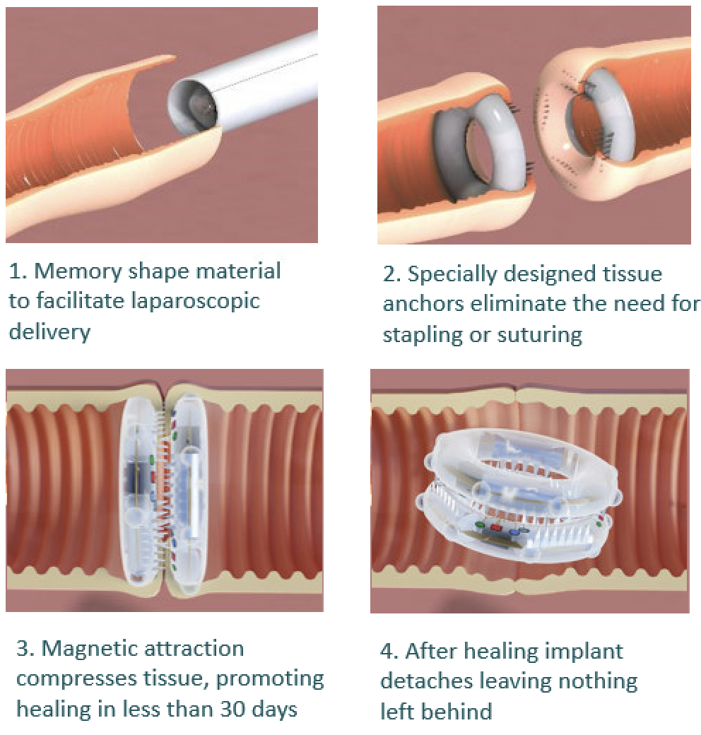 SMARTHEAL - a novel approach to GI anastomosis