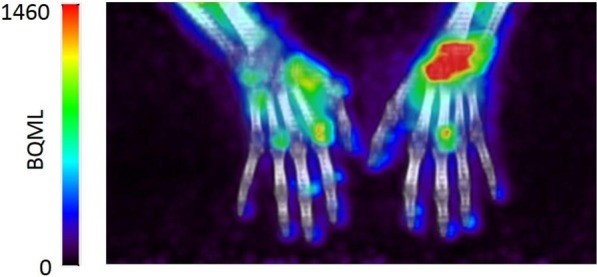 Een voorbeeld van foto’s van de ontwikkelde beeldtechniek waarop de ontstekingen (rood-gele kleuren) in gewrichten van de handen zichtbaar zijn. Bron: Nature: (2020) 10:1047 |