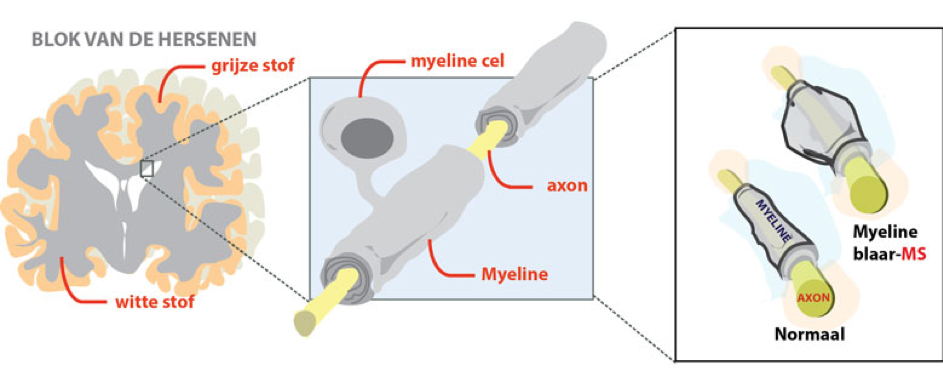 An infographic that illustrated the difference between a normal axon and a axon of a MS patient