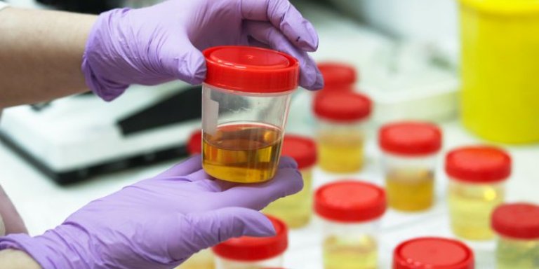 Scientists can detect brain tumors by analyzing urine