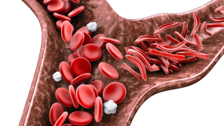 Stamceltransplantatie geneest sikkelcelziekte bij volwassenen