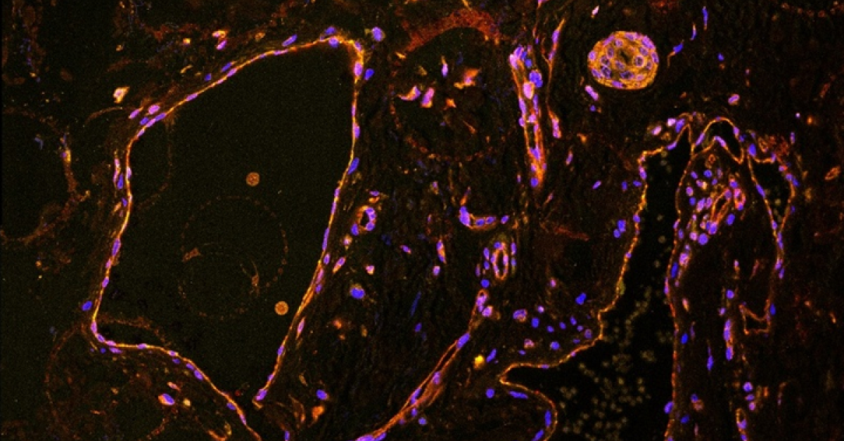 Pathogenesis Cascade Discovery of Pathogenic Signaling Cascade Reveals Therapeutic Target ...