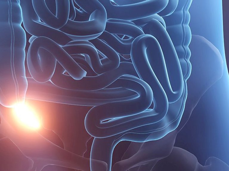 Worldwide study on neuroendocrine tumors of the appendix in children (Appendix NET-study)