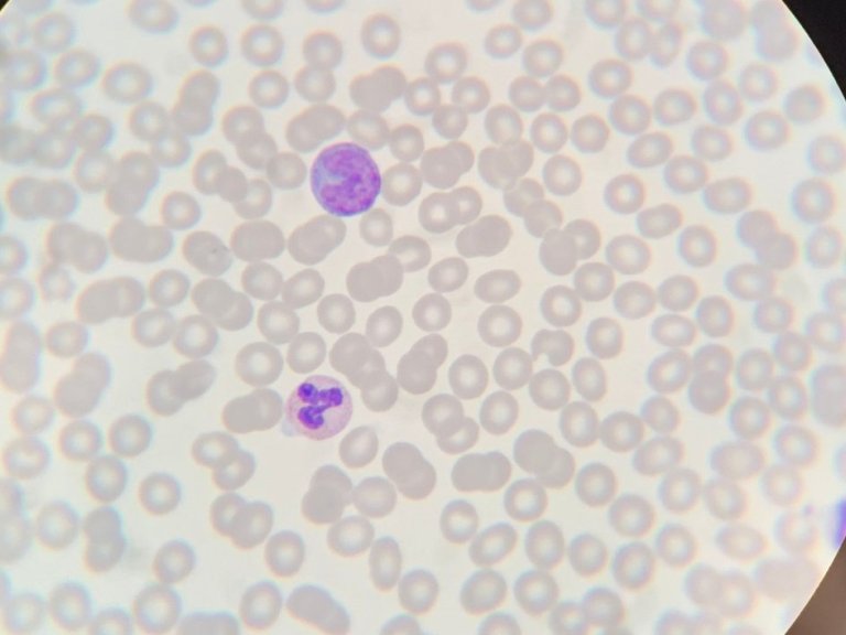 Temporary benefit for immune system in early HIV treatment, but dysregulation returns