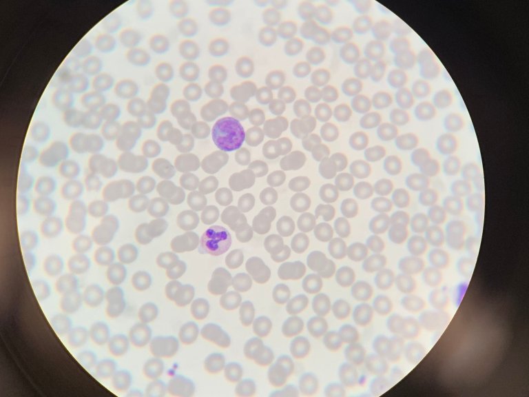 Vroege hiv-behandeling helpt slechts tijdelijk tegen ontregeling afweersysteem