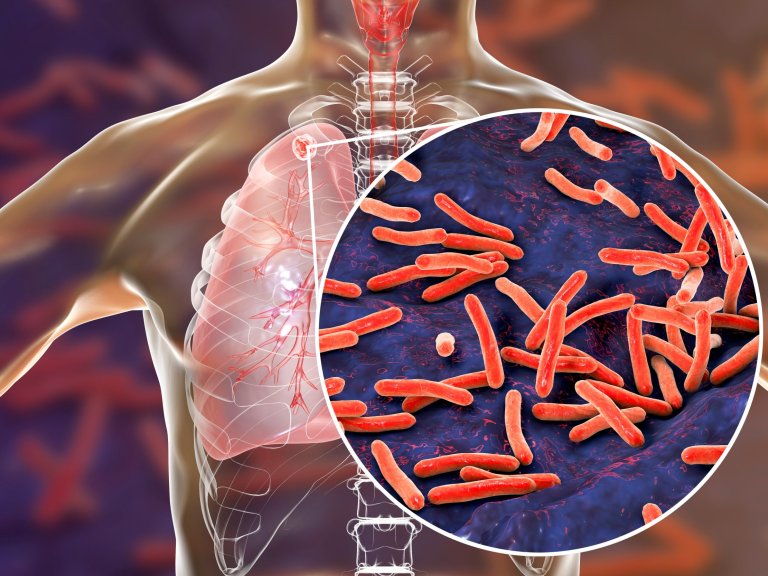Aanknopingspunt voor nieuwe behandeling tuberculose ontdekt 