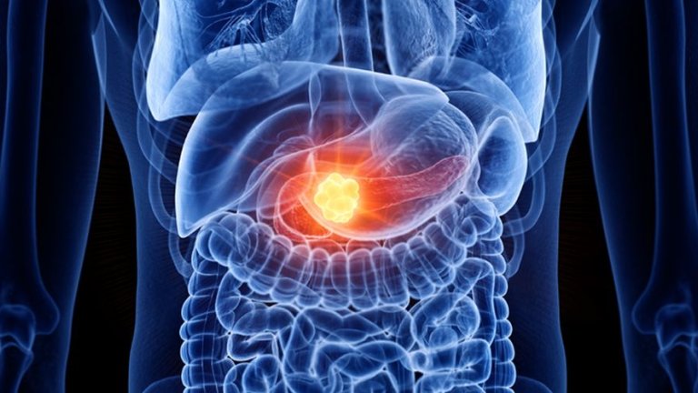 New Artificial Intelligence model for histopathological detection of pancreatic cancer