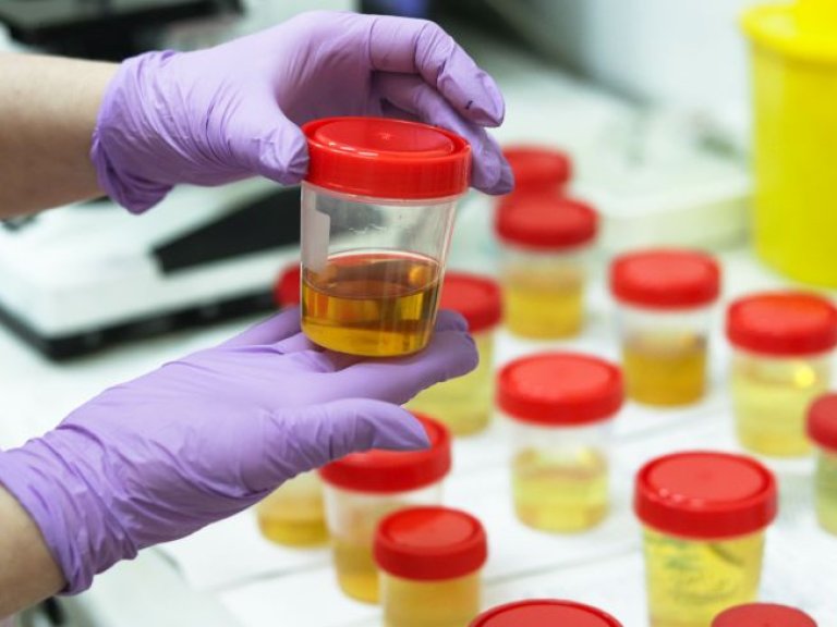 Scientists can detect brain tumors by analyzing urine