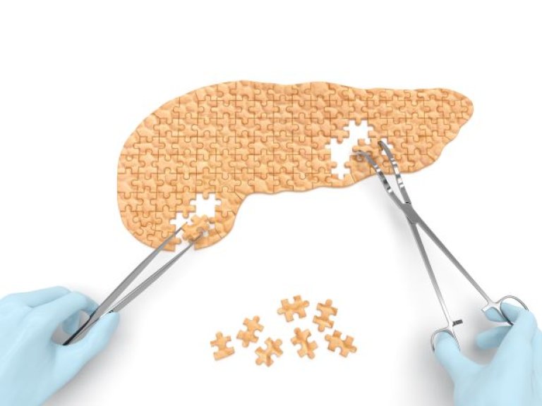   DIPLOMA trial: a clinical study to determine safety and effectiveness of minimally invasive versus open surgery in pancreatic cancer  