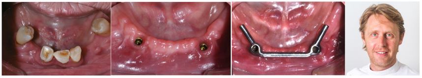 Dental implants in individuals with Sjögren's syndrome a research project by Derk Jan Jager, Assistant professor at Amsterdam UMC