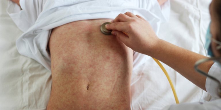 Hoe mazelen het immuunsysteem wist