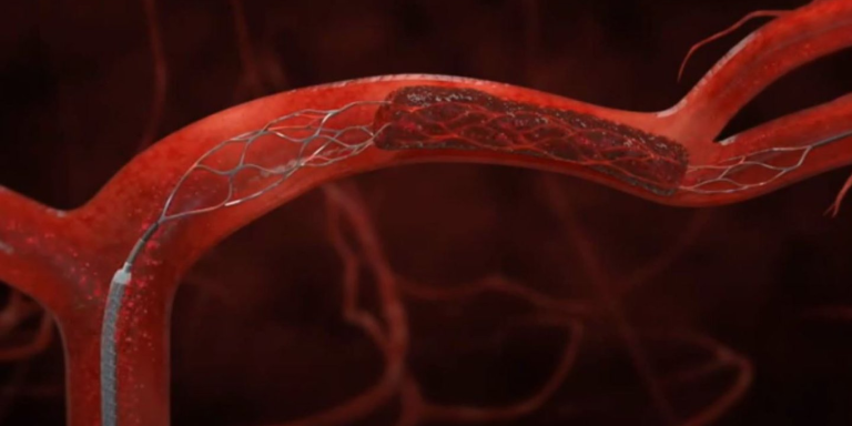 Clot dissolver after stroke makes no difference for recovery  
