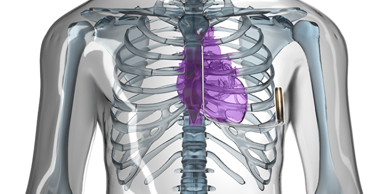 Nieuwe onderhuidse hartdefibrillator even veilig als traditionele type