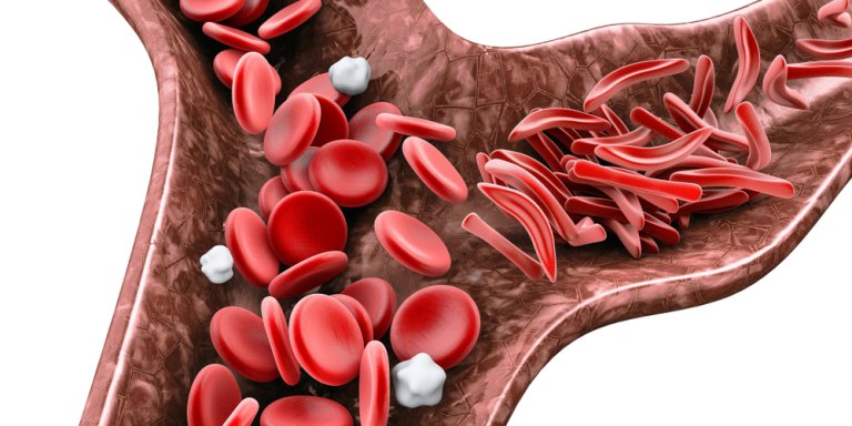 Stamceltransplantatie geneest sikkelcelziekte bij volwassenen