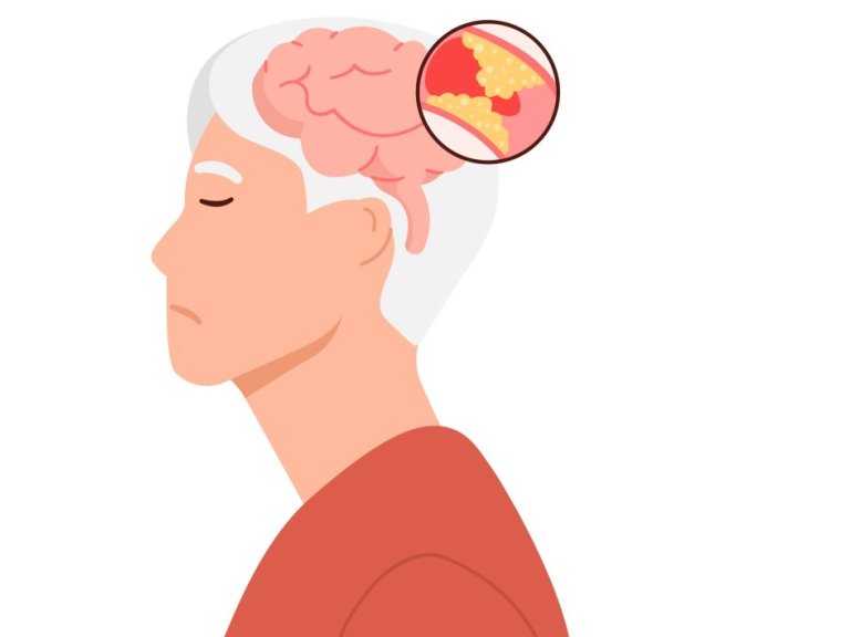 Phase 3 trial shows a reduction in recurrent ischemic stroke