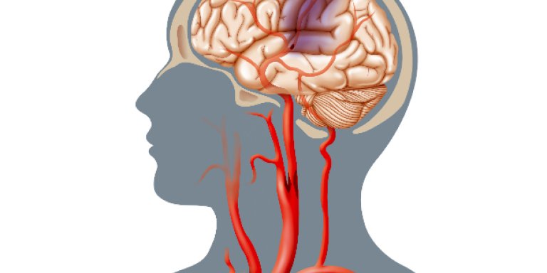 Medicijn dat stolsel oplost niet altijd nodig bij  acuut herseninfarct