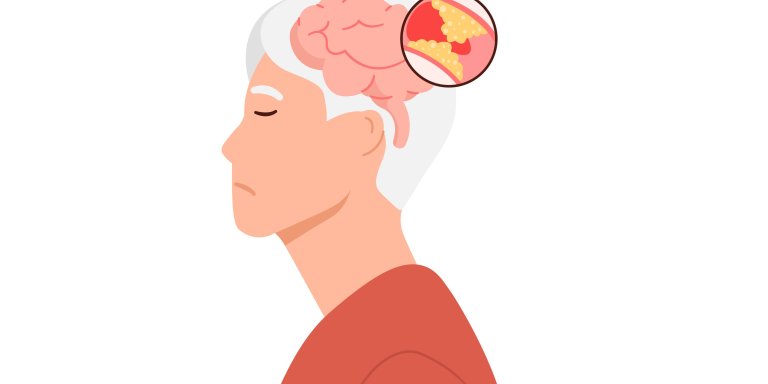 Nieuw medicijn verkleint kans op nieuwe beroerte