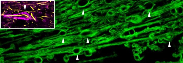 Myelin swellings as observed under the microscope from the VU LaserLab. Top left: myelin swelling fixed in MS brain material. 
