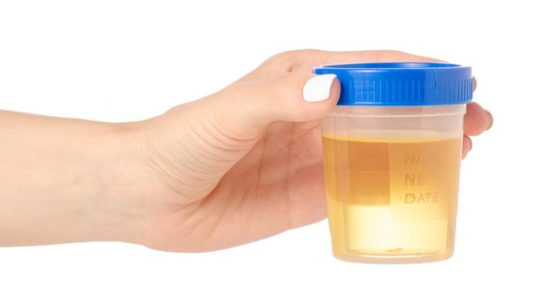 Urine test to boost participation in cervical cancer population screening