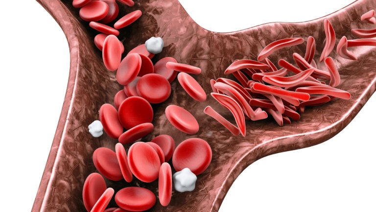Normale, ronde bloedcellen en sikkelvormige bloedcellen in een bloedvat. Foto: Shutterstock