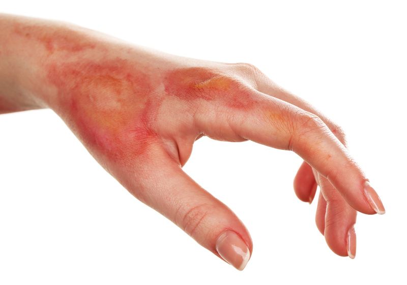 How to regenerate injured skin without scars