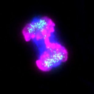 Image from a patient cell showing abnormal chromosome separation in anaphase (Raquel Oliveira).