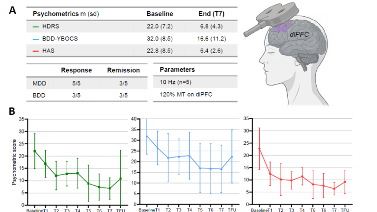 Repetitive Transcranial Magnetic Stimulation (rTMS) of the left dorsolateral prefrontal cortex (dlPFC) in five patients with BDD and Major Depressive Disorder (MDD).