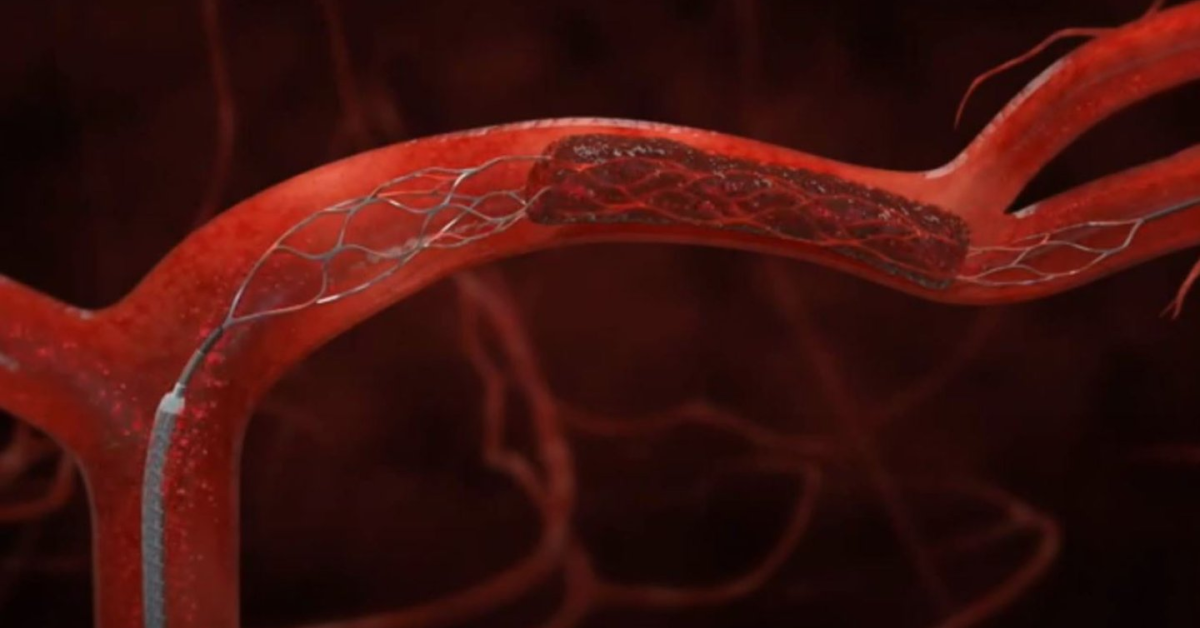 Clot dissolver after stroke makes no difference to recovery | Amsterdam UMC